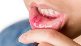口内炎の正しい治し方は？ 治療・予防に役立つ10のポイント